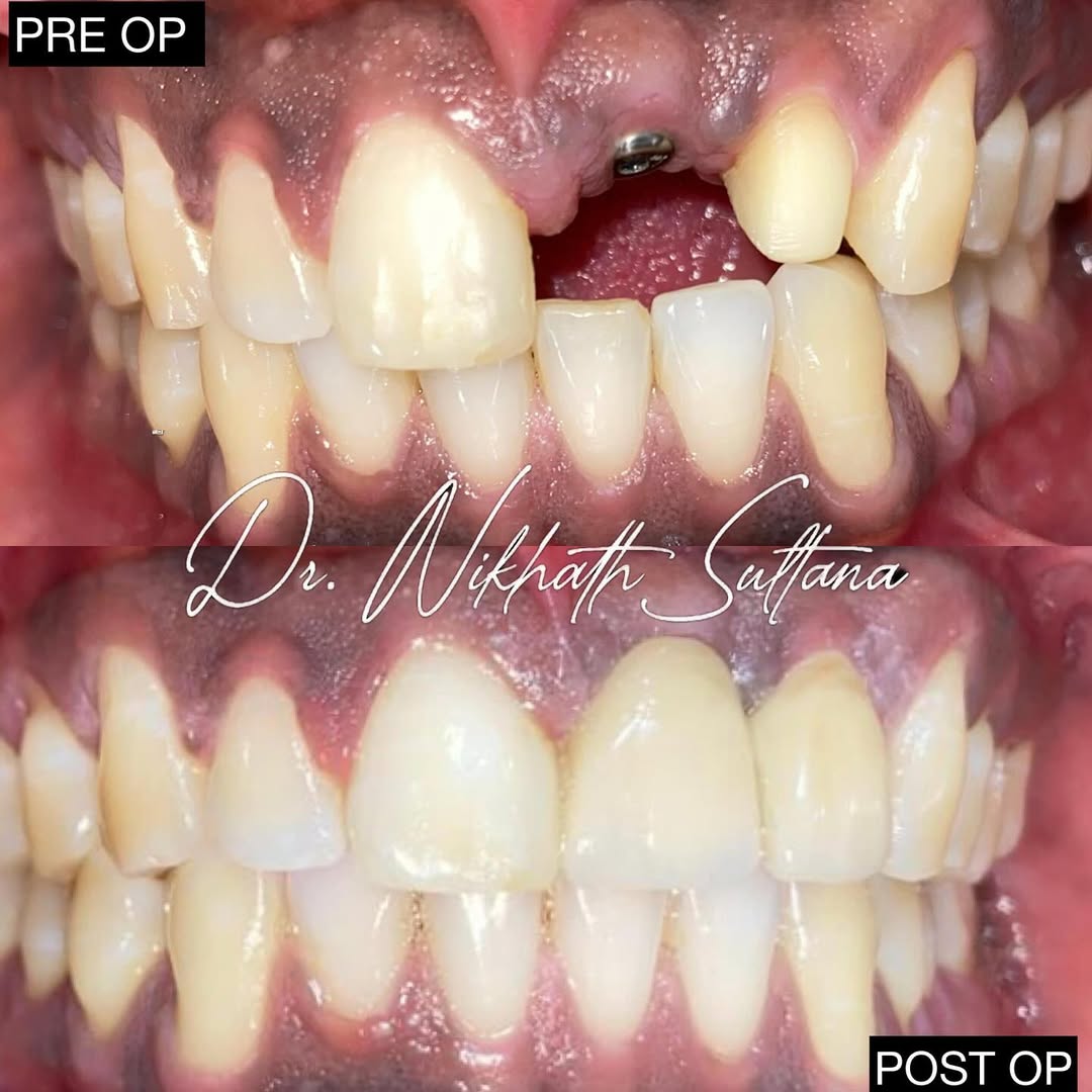 Veneers Case 2